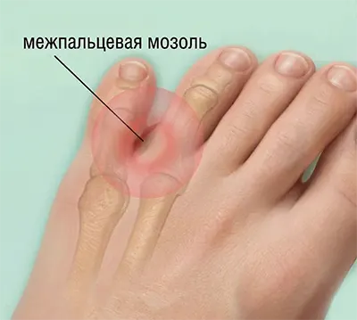 Межпальцевая мозоль