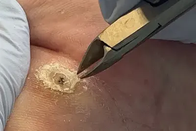 Стержневая мозоль