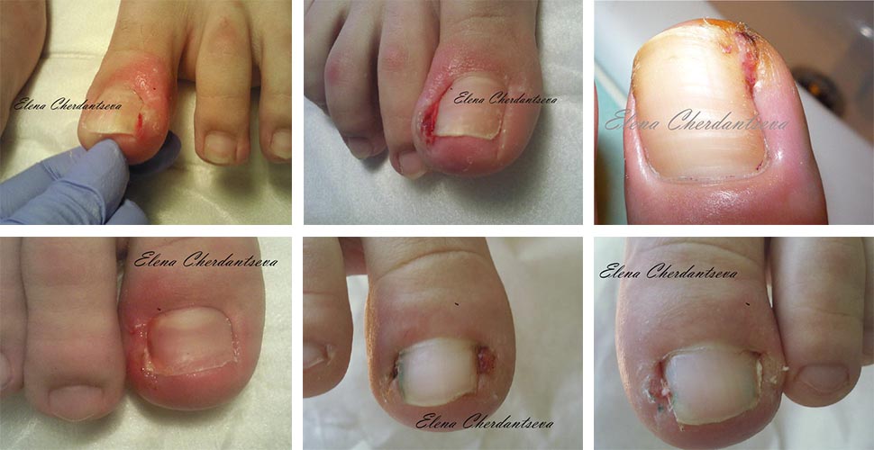 Причины возникновения патологии вросшего ногтя