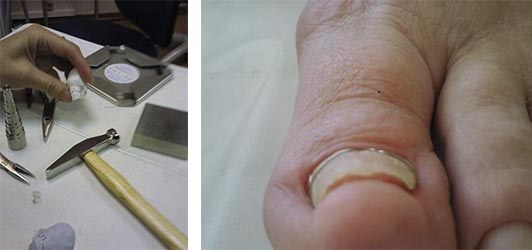 Коррекция вросшего ногтя методом установки скобы Фрезера